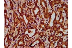 IHC image of ABIN7151907 diluted at 1:300 and staining in paraffin-embedded human liver cancer performed on a Leica BondTM system. (EGFL7 antibody  (AA 73-198))