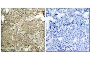 Immunohistochemical analysis of paraffin-embedded human breast carcinoma tissue using cofilin (phospho-Ser3) antibody (E011139). (Cofilin antibody  (pSer3))