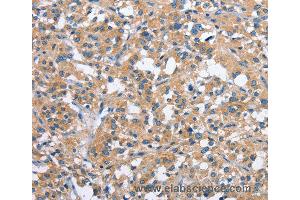 Immunohistochemistry of Human thyroid cancer using PAK2 Polyclonal Antibody at dilution of 1:40 (PAK2 antibody)