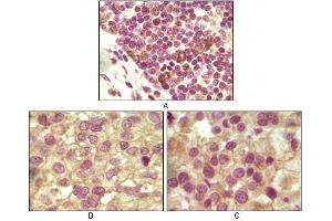 Immunohistochemical analysis of paraffin-embedded human lymphoid (A), ovary tumor (B) and testicle tumor (C) tissues using INHA antibody with DAB staining.