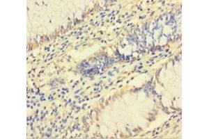 Immunohistochemistry of paraffin-embedded human colon cancer using ABIN7142784 at dilution of 1:100 (RPL26L1 antibody  (AA 1-145))