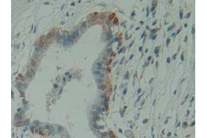 Detection of HMBS in Human Pancreas cancer Tissue using Polyclonal Antibody to Hydroxymethylbilane Synthase (HMBS) (HMBS antibody  (AA 85-337))