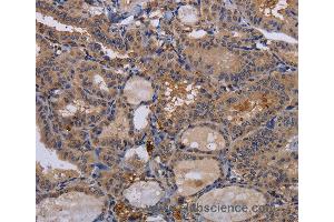 Immunohistochemistry of Human thyroid cancer using FADS1 Polyclonal Antibody at dilution of 1:60 (FADS1 antibody)