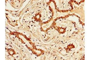 IHC image of ABIN7157190 diluted at 1:300 and staining in paraffin-embedded human breast cancer performed on a Leica BondTM system. (Kallikrein 1 antibody  (AA 25-262))