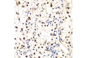 Immunohistochemistry of paraffin-embedded human kidney cancer using NFKBIB antibody (ABIN5973399) at dilution of 1/200 (40x lens).