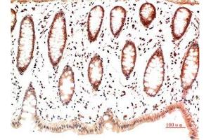 Immunohistochemical analysis of paraffin-embedded Human Colon Carcinoma Tissue using Collagen I Mouse mAb diluted at 1:200. (COL1A1 antibody)