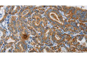 Immunohistochemistry of paraffin-embedded Human thyroid cancer using UPF1 Polyclonal Antibody at dilution of 1:35 (RENT1/UPF1 antibody)