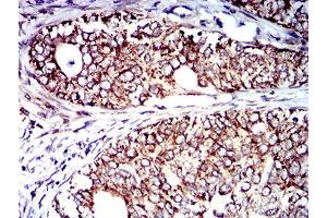 Immunohistochemical analysis of paraffin-embedded cervical cancer tissues using CD129 mouse mAb with DAB staining. (IL9 Receptor antibody  (AA 41-270))