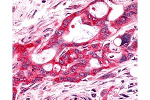 Anti-FZD9 / Frizzled 9 antibody IHC of human Pancreas, Carcinoma. (FZD9 antibody  (N-Term))