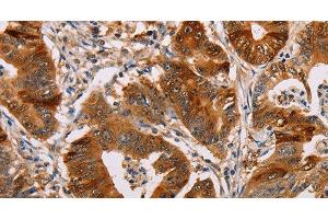 Immunohistochemistry of paraffin-embedded Human gastic cancer using ALDH3A1 Polyclonal Antibody at dilution of 1:55 (ALDH3A1 antibody)