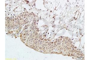 Formalin-fixed and paraffin embedded human cervical cancer labeled with Anti-PAR3 Polyclonal Antibody, Unconjugated (ABIN681718) at 1:200 followed by conjugation to the secondary antibody and DAB staining