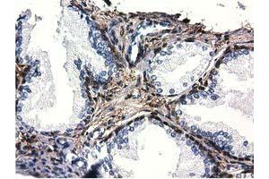 Immunohistochemical staining of paraffin-embedded Adenocarcinoma of Human ovary tissue using anti-QPRT mouse monoclonal antibody.