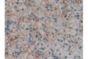 DAB staining on IHC-P; Samples: Human Renal cancer Tissue (TOR1AIP2 antibody  (AA 249-476))
