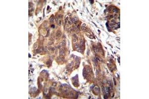 Immunohistochemistry analysis in formalin fixed and paraffin embedded human bladder carcinoma reacted with  Glomulin Antibody (C-term) followed by peroxidase conjugation of the secondary antibody and DAB staining. (GLMN antibody  (C-Term))