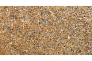 Immunohistochemistry of paraffin-embedded Human liver cancer tissue using RAB35 Polyclonal Antibody at dilution 1:50 (RAB35 antibody)