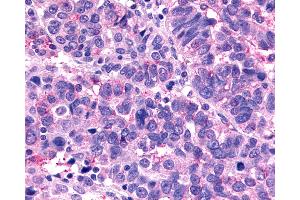 Anti-MRGX1 / MRGPRX1 antibody IHC of human Ovary, Carcinoma. (MRGPRX1 antibody  (N-Term))