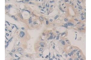 Detection of CPB1 in Human Bile duct cancer Tissue using Polyclonal Antibody to Carboxypeptidase B1, Tissue (CPB1) (CPB1 antibody  (AA 111-417))