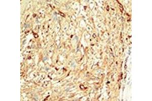 IHC analysis of FFPE human breast carcinoma tissue stained with the MST1 antibody (STK4 antibody  (AA 385-415))
