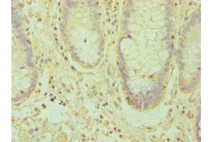 Immunohistochemistry of paraffin-embedded human colon cancer using ABIN7151874 at dilution of 1:100 (Ephrin A1 antibody  (AA 19-182))