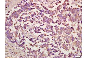 Formalin-fixed and paraffin embedded human lung carcinoma labeled with Anti-Megalin Polyclonal Antibody, Unconjugated (ABIN750988) at 1:200 followed by conjugation to the secondary antibody and DAB staining