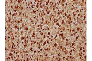 IHC image of ABIN7171666 diluted at 1:300 and staining in paraffin-embedded human glioma performed on a Leica BondTM system. (Tiparp antibody  (AA 74-178))