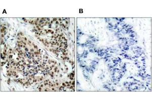 Immunohistochemical staining of paraffin-embbeded human breast carcinoma tissue using FOXO1 (phospho S256) polyclonal antibody  (A) or preincubated with blocking peptide (B). (FOXO1 antibody  (pSer256))
