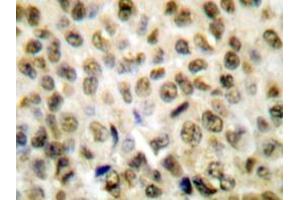 Immunohistochemistry analyzes of Histone H1 antibody in paraffin-embedded human lung carcinoma tissue.