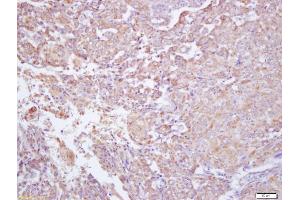 Formalin-fixed and paraffin embedded human labeled with Anti-IFNGR2 Polyclonal Antibody, Unconjugated (ABIN749483) at 1:200 followed by conjugation to the secondary antibody and DAB staining (RTN4RL2 antibody  (AA 241-337))