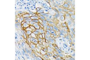 Immunohistochemistry of paraffin-embedded human lung cancer using GRIK2 Rabbit mAb (ABIN7267415) at dilution of 1:100 (40x lens).