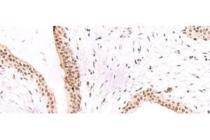 Immunohistochemistry of paraffin-embedded Human breast cancer tissue using CBFA2T2 Polyclonal Antibody at dilution of 1:60(x200) (CBFA2T2 antibody)
