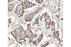 Immunohistochemistry of paraffin-embedded Human mammary cancer using KRT81 Polyclonal Antibody at dilution of 1:100 (40x lens).