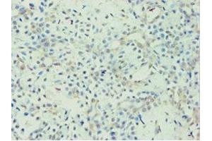 Immunohistochemistry of paraffin-embedded human breast cancer using ABIN7144436 at dilution of 1:100 (APOL1 antibody  (AA 179-398))