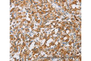 Immunohistochemistry of Human liver cancer using BDH1 Polyclonal Antibody at dilution of 1:60