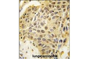 Formalin-fixed and paraffin-embedded human lung carcinoma tissue reacted with SENP5 Antibody (C-term) (ABIN388050 and ABIN2845616) , which was peroxidase-conjugated to the secondary antibody, followed by DAB staining. (SENP5 antibody  (C-Term))