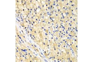 Immunohistochemistry of paraffin-embedded human lung cancer using NUP62 antibody (ABIN5971334) at dilution of 1/100 (40x lens). (NUP62 antibody)