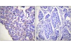 Immunohistochemistry analysis of paraffin-embedded human breast carcinoma, using Caldesmon (Phospho-Ser789) Antibody. (Caldesmon antibody  (pSer789))