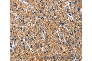 Immunohistochemistry of Human thyroid cancer using CEACAM3 Polyclonal Antibody at dilution of 1:70
