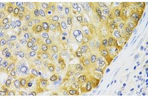 Immunohistochemistry of paraffin-embedded Human liver cancer using PA2G4 Polyclonal Antibody at dilution of 1:100 (40x lens). (PA2G4 antibody)