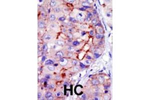 Formalin-fixed and paraffin-embedded human hepatocellular carcinoma tissue reacted with CAMK1D polyclonal antibody  , which was peroxidase-conjugated to the secondary antibody, followed by DAB staining. (CAMK1D antibody  (C-Term))