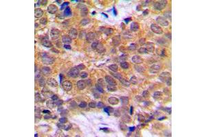 Immunohistochemical analysis of RCBTB1 staining in human breast cancer formalin fixed paraffin embedded tissue section. (RCBTB1 antibody  (Center))