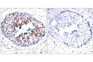 Immunohistochemistry analysis of paraffin-embedded human breast carcinoma, using STAT5A (Phospho-Ser780) Antibody. (STAT5A antibody  (pSer780))