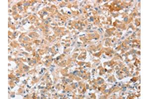 The image on the left is immunohistochemistry of paraffin-embedded Human thyroid cancer tissue using ABIN7131058(SIGLEC9 Antibody) at dilution 1/40, on the right is treated with fusion protein.