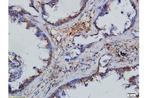 Formalin-fixed and paraffin embedded human endometrial cancer labeled with Anti-CCL19/MIP-3 beta Polyclonal Antibody, Unconjugated followed by conjugation to the secondary antibody