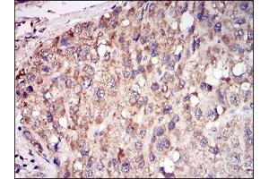 Immunohistochemical analysis of paraffin-embedded liver cancer tissues using ACP5 mouse mAb with DAB staining.