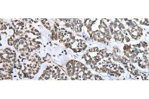 Immunohistochemistry of paraffin-embedded Human esophagus cancer tissue using CARTPT Polyclonal Antibody at dilution of 1:25(x200) (CARTPT antibody)