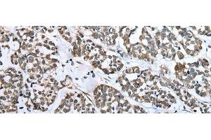 Immunohistochemistry of paraffin-embedded Human esophagus cancer tissue using CARTPT Polyclonal Antibody at dilution of 1:25(x200)
