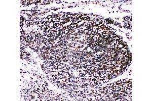 Anti-TRAF4 antibody, IHC(P) IHC(P): Human Lung Cancer Tissue (TRAF4 antibody  (C-Term))