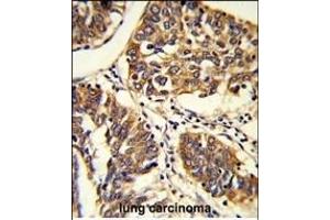 Formalin-fixed and raffin-embedded human lung carcinoma reacted with BPC1 Antibody (Center), which was peroxidase-conjugated to the secondary antibody, followed by DAB staining. (PABP antibody  (AA 250-279))