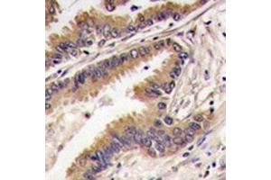 IHC analysis of FFPE human lung carcinoma tissue stained with ERK4 antibody (MAPK7 antibody  (AA 527-557))
