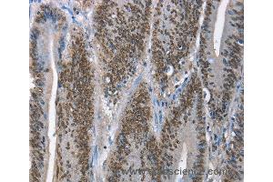 Immunohistochemistry of Human lung cancer using GNRH1 Polyclonal Antibody at dilution of 1:65
